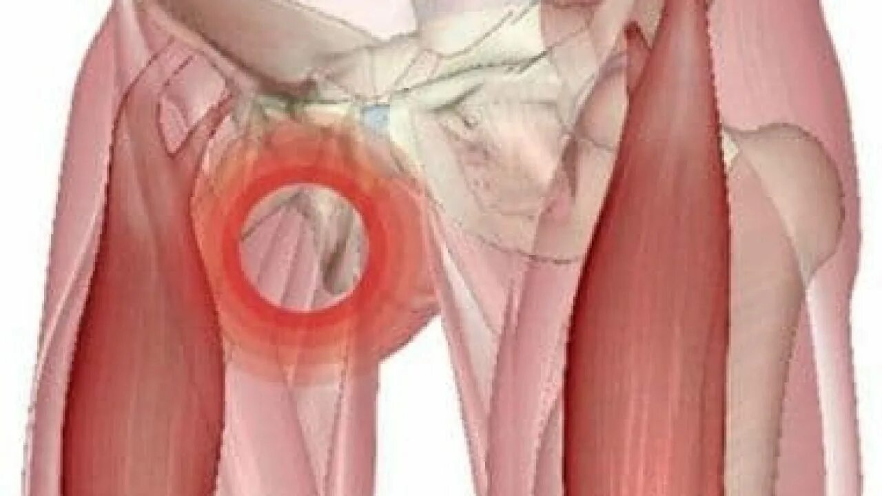 Тейпирование мышц бедра при растяжении. Триггерные точки портняжная мышца. Растяжение мышц паха. Паховые мышцы у женщин. Реабилитация растяжение паховых связок.