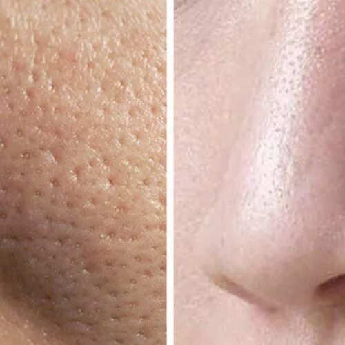 Как бороться с расширенными порами. Как бороться с расширенными порами. Как бороться с расширенными порами. Расширенные поры на люц. Как бороться с расширенными порами.