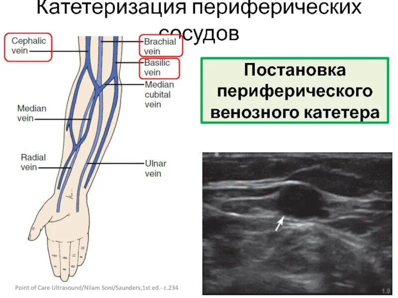 Периферическая вена где