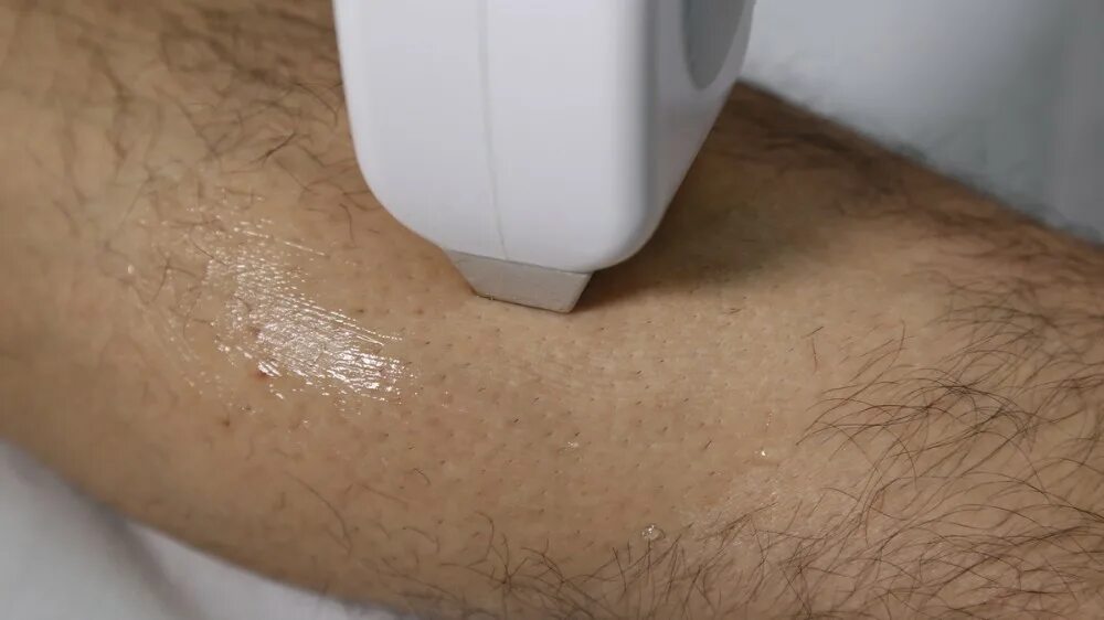 лазерная эпиляция скидки. диодный лазер для эпиляции до и после. диодный лазер для эпиляции эффективность. лазерная эпиляция скидки. лазерная эпиляция.