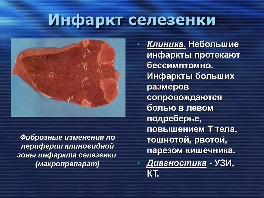 Геморрагический инфаркт селезенки. Ишемический инфаркт селезенки. Инфаркт селезенки патанатомия. Инфаркт селезенки макропрепарат. Цена селезенки