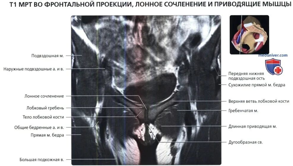 Боль в лонном сочленении