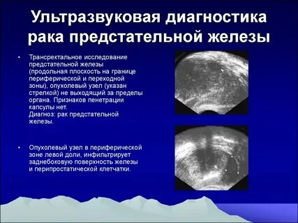 Что такое диффузные изменения предстательной железы
