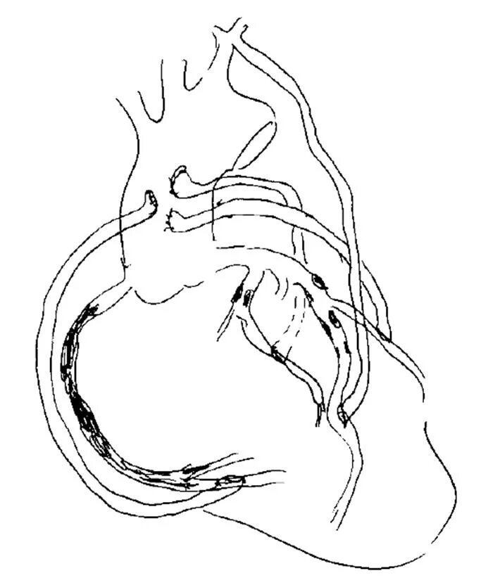 Маммарно коронарное шунт. Маммарокоронарный анастомоз. Аортокоронарное шунтирование кт. Как делают коронарное шунтирование