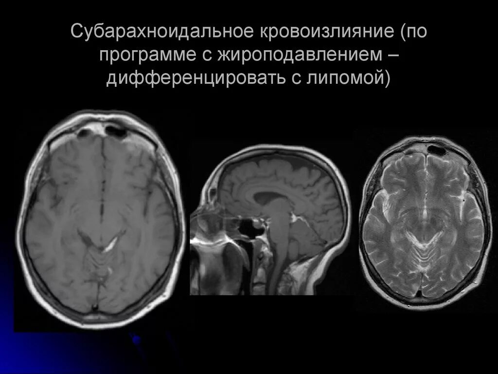 Субарахноидальное пространство на кт. Субарахноидальное субарахноидальное кровоизлияние. Конвекситальное субарахноидальное пространство. Субарахноидальные кровоизлияния на мрт. Умеренно расширение конвекситальных пространств