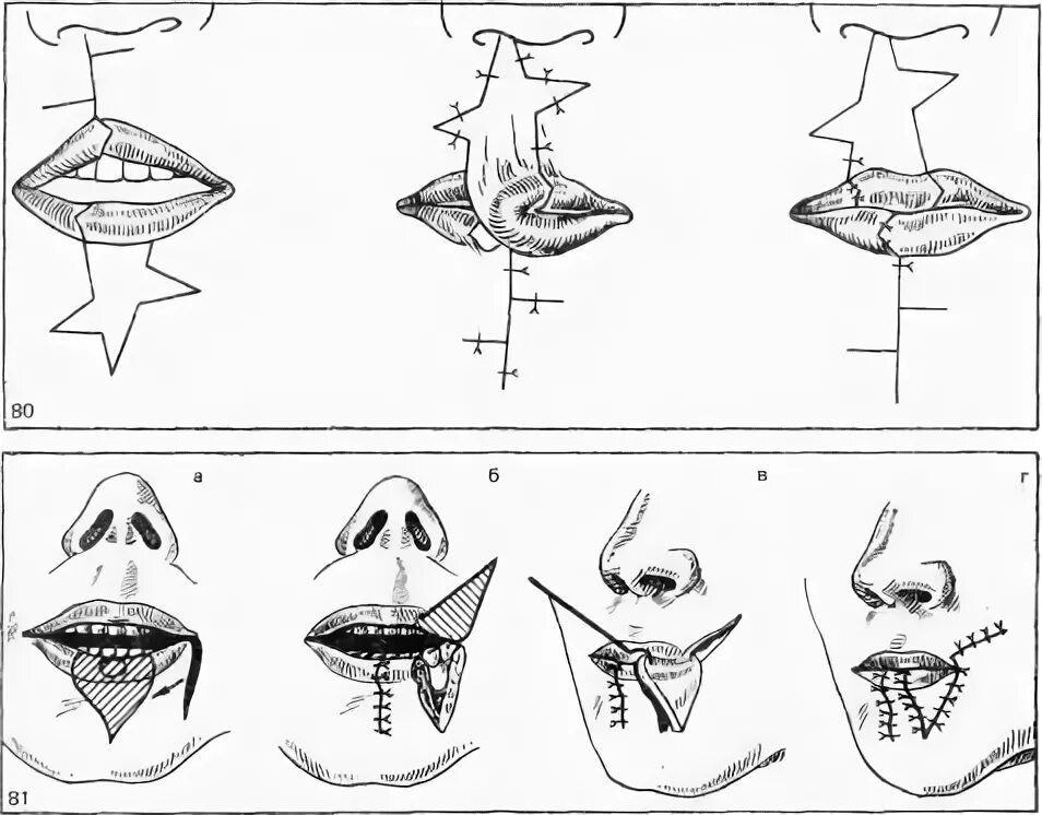 Операция нижней губы. Пластика верхней губы по Аббе. Пластика расщелины верхней губы по Аббе. Пластика губы по Лимбергу. Пластика губ операция Аббе.