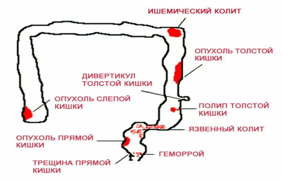 Жжение при дефекации