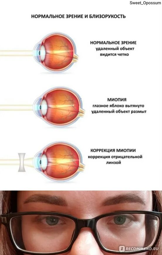 Зрение плюс отзывы. Лазерная коррекция зрения миопия -3. Осложнения лазерной коррекции зрения ласик. Лазерная корректировка зрения. Операция на близорукость лазером.