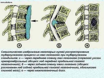 Туберкулез позвоночника что это