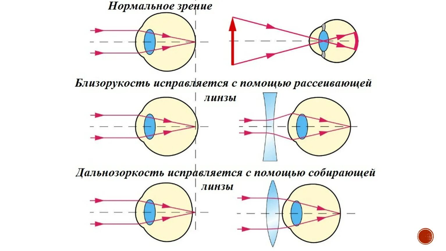 Рациональная точка зрения. Схема близорукости и дальнозоркости. Близорукость и дальнозоркость схема глаза. Ход лучей при нормальном зрении, близорукости, дальнозоркости. Зрение человека дальнозоркость и близорукость.