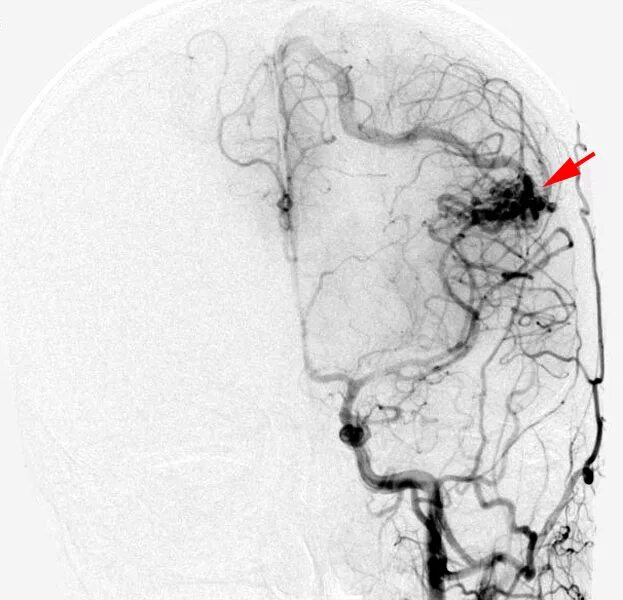 Сосудистая аномалия. Артериовенозная мальформация (АВМ). АВМ мальформация сосудов головного мозга. Артериовенозная мальформация сосудов головного мозга на кт. Артериовенозная мальформация ангиограмма.