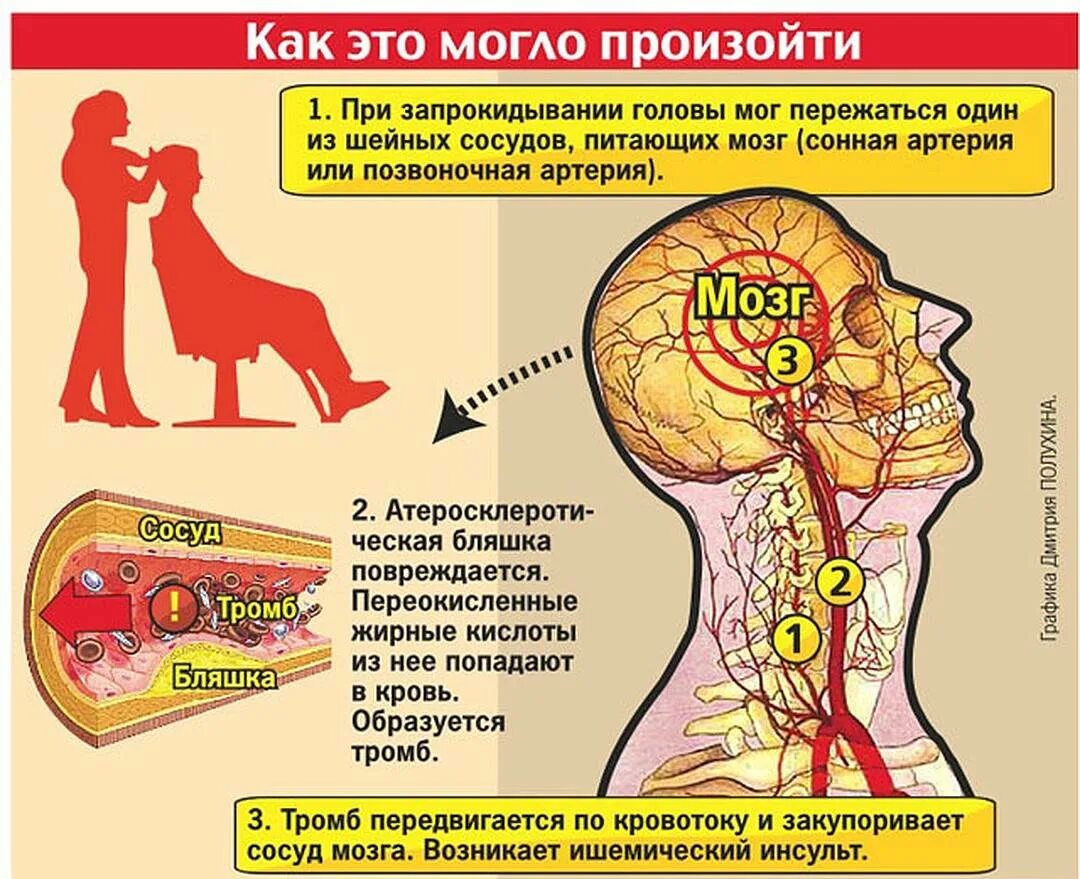 Атеросклероз сосудов головного мозга. Сосуды при атеросклерозе. Атеросклероз артерий головного мозга симптомы. Атеросклеротические поражения головного мозга. Симптомы проблем с сосудами головного