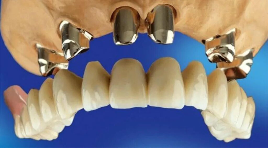 Телескопическая система фиксации бюгельных протезов. Телескопический бюгельный протез. Телескопические коронки для бюгельных протезов. Бюгельные протезы на телескопических коронках. Как крепятся съемные