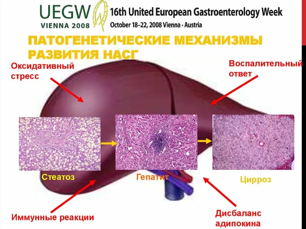 Стеатоз печени механизм. Стеатоз печени механизм формирования. Неалкогольный стеатогепатит.