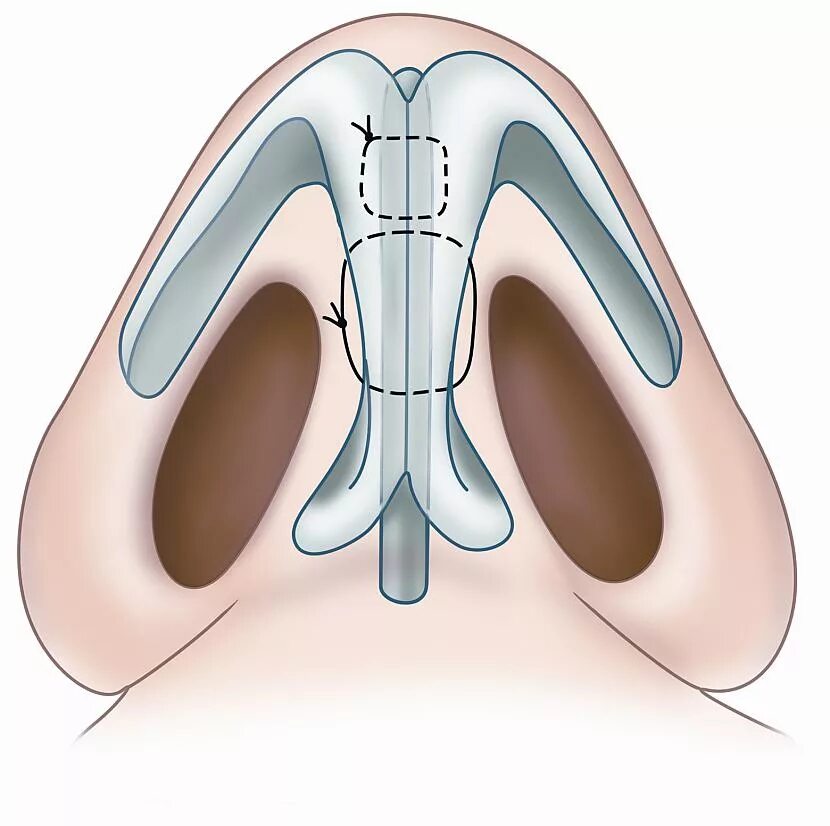 Септопластика носа искривление. Искривленная перегородка. Искривленная носовая перегородка. Перегородка носа без операции