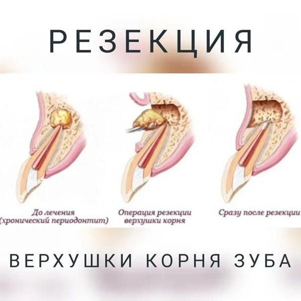 Цистэктомия кисты челюсти. Операция цистэктомия с резекцией верхушки корня. Резекция верхушки корня зуба с ретроградным пломбированием. Ретроградная пломбировка канала. Ретроградное пломбирование верхушки корня.