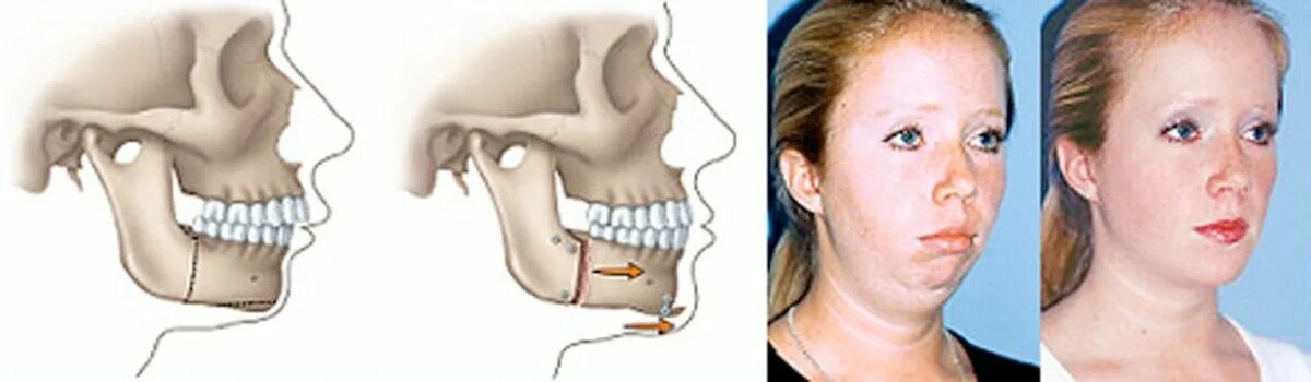 Удлиненная челюсть. ВНЧС дистальный прикус. Дистальный прикус операция. Дистальный прикус прогнатия.
