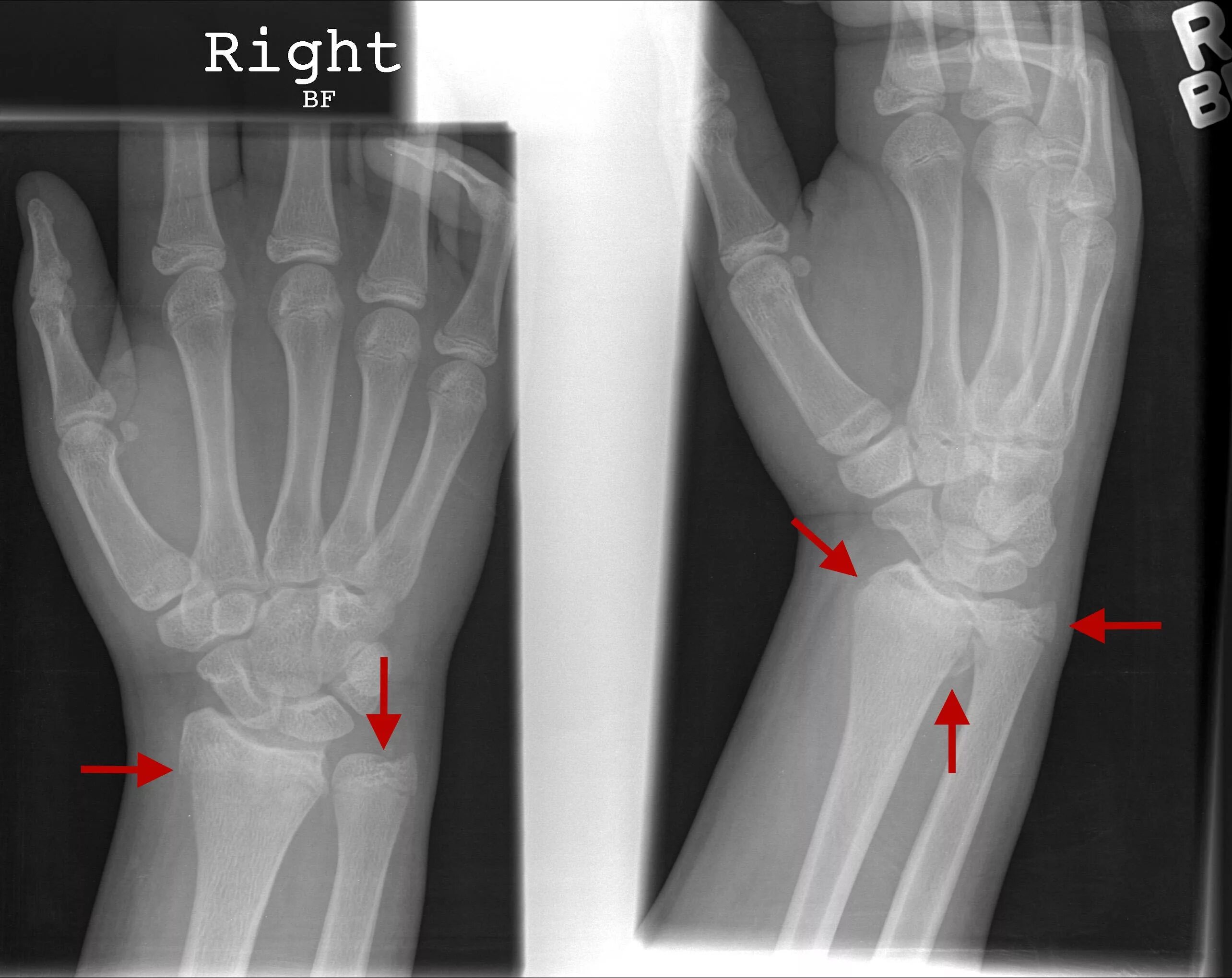 Смещение кости на руке без перелома. Внутрисуставной перелом лучевой кости рентген. Перелом лучезапястного сустава в типичном месте рентген. Перелом лучевой кости рентген. Поднадкостничный перелом лучевой кости.