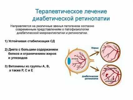 Диабетическая ретинопатия симптомы