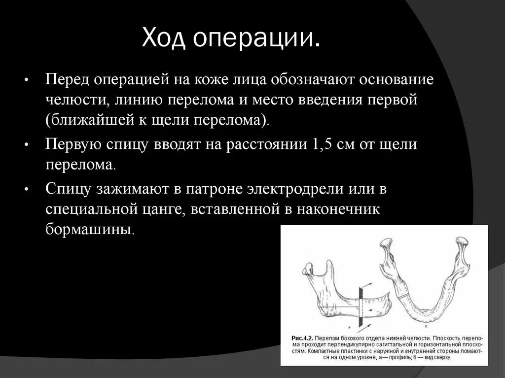 Суть операции преображенского. Непрерывный ход операции.