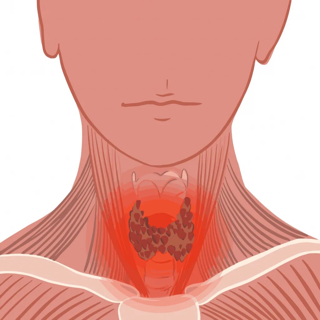 Острый тиреоидит щитовидной железы. Хронический тиреоидит ЩЖ. Тиреоидит воспаление щитовидной. Подострый тиреоидит щитовидной железы. Зоб в горле