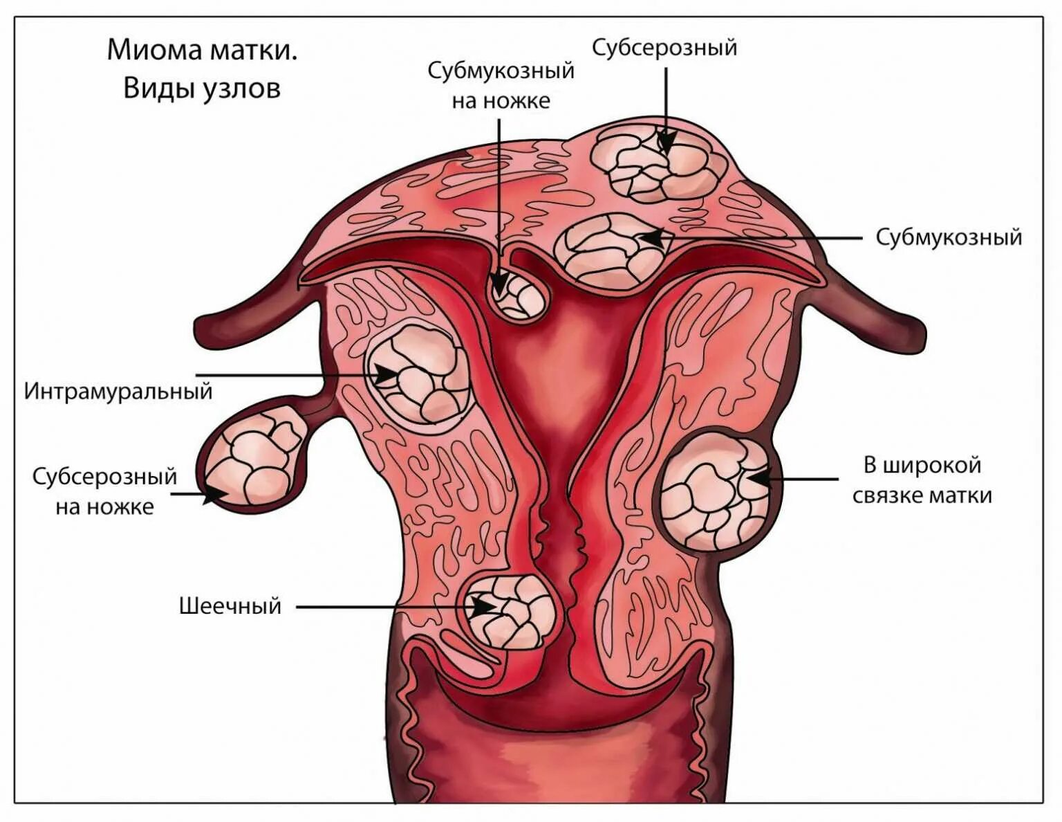 Миома матки на ранних сроках. Множественная субсерозная миома матки. Миоматозные узлы в матке. Субсерозная лейомиома матки. Миоматозные узлы расположение.