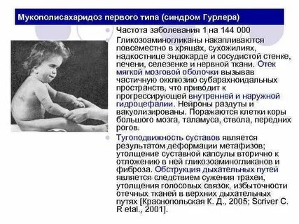 Мукополисахаридоз тип i нмо ответы. Мукополисахаридоз тип i нмо ответы. Мукополисахаридоз тип i нмо ответы. Мукополисахаридоз тип i нмо ответы. Мукополисахаридоз тип i нмо ответы.