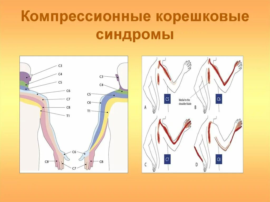 Корешковое поражение. Компрессионный синдром. Компрессионокорешковый синдром. Компрессионный корешковый синдром s1. Компрессионные корешковые синдромы остеохондроза.