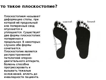 Характеристика плоскостопия москва
