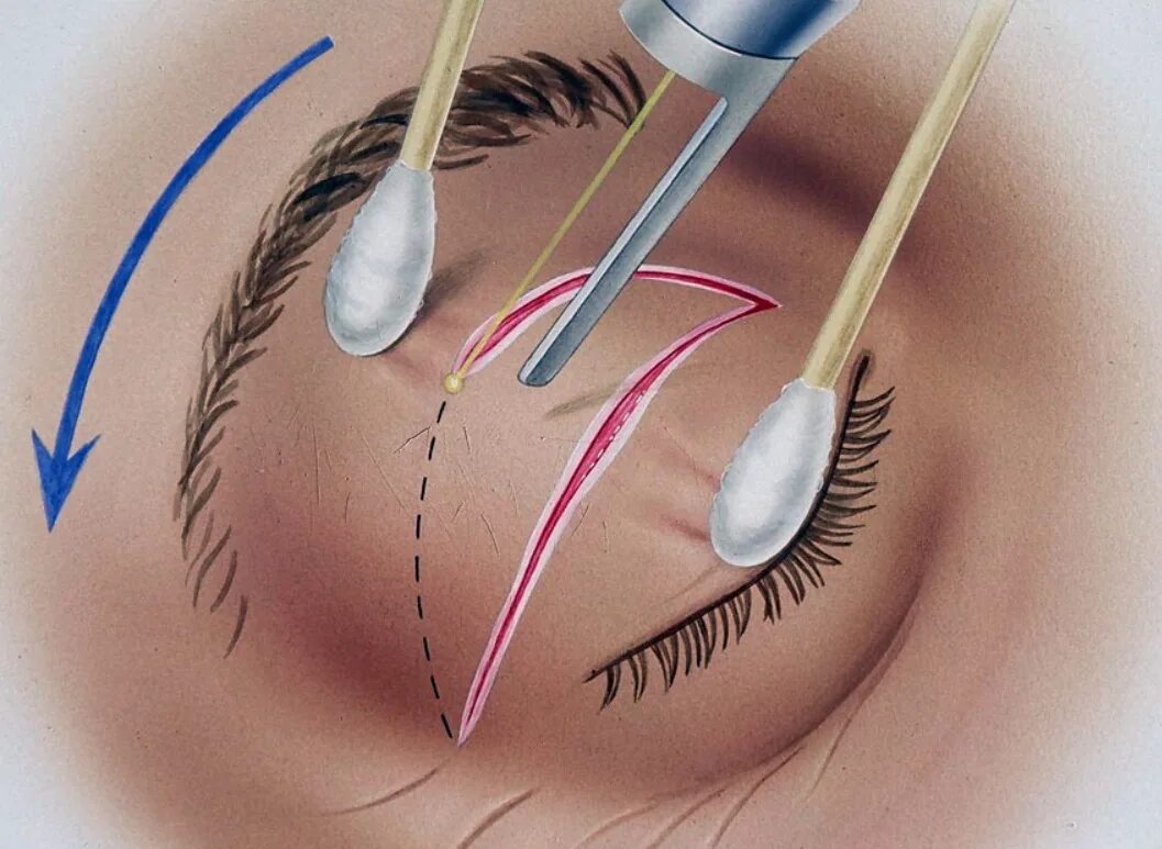 Бреют веки. Лазерная блефаропластика век. Лазерный блефаролифтинг. Блефарохалазис операция. Блефаропластика трансконъюктивальная (2 века).