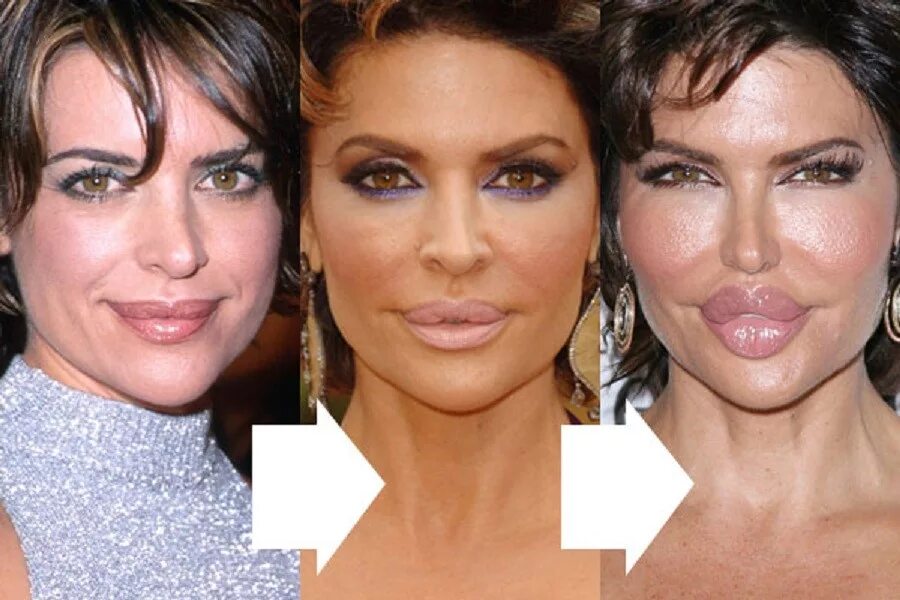 Как меняются губы. Лиза ринна губы. lisa rinna before. неудачные пластические операции. последствия пластики лица.