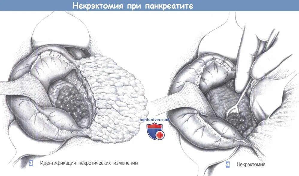 Операция при остром панкреатите. Некрэктомия поджелудочной железы. Операция Лоусона поджелудочной железы. Операции при остром панкреатите.