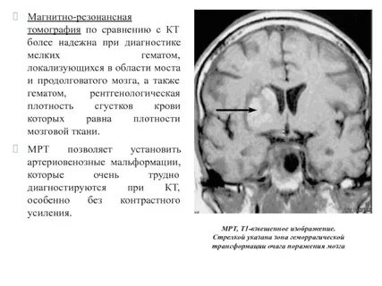 Геморрагическая трансформация ишемического инсульта