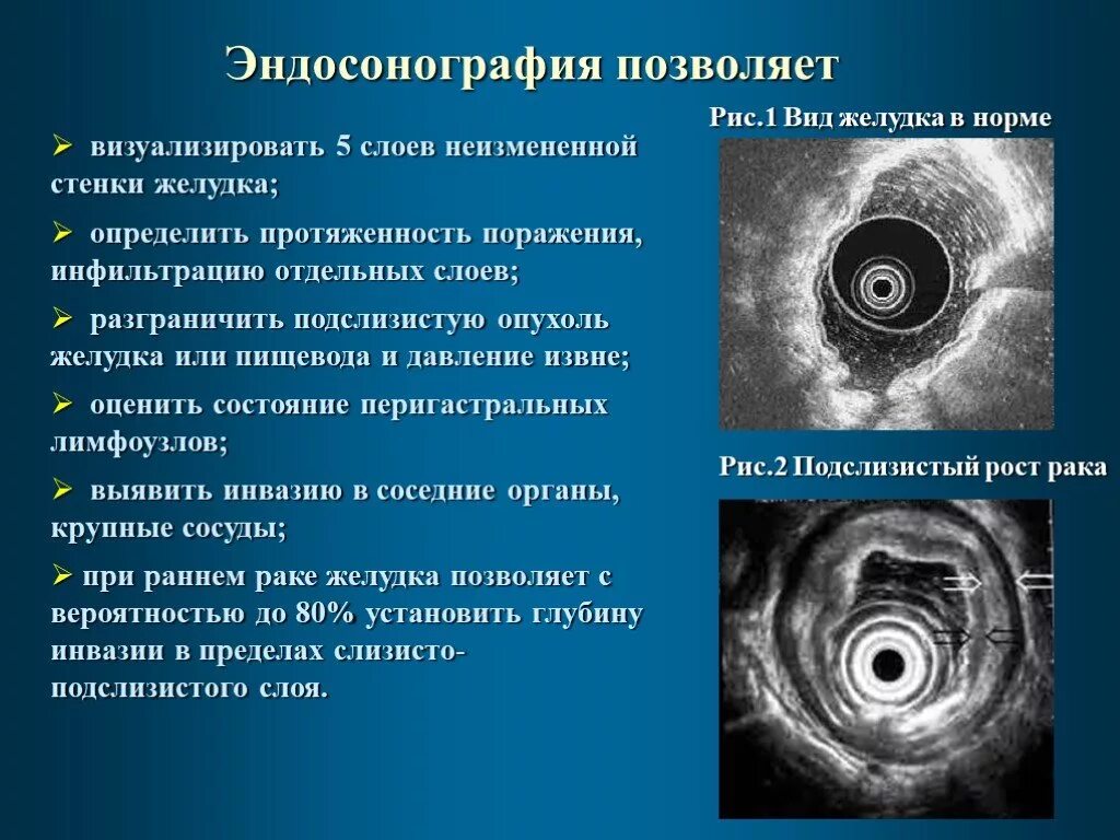 Эндосонография двенадцатиперстной кишки. Эндоскопическая ультрасонография желудка. Эндосонография(ЭНДОУЗИ). Эндоскопическая ультрасонография пищевода. Эус желудка