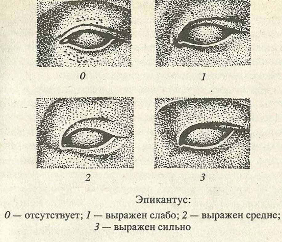 Эпикантус монгольская складка. Складка верхнего века эпикантус. Веко складка верхнее эпикантус. Монголоидная складка верхнего века.