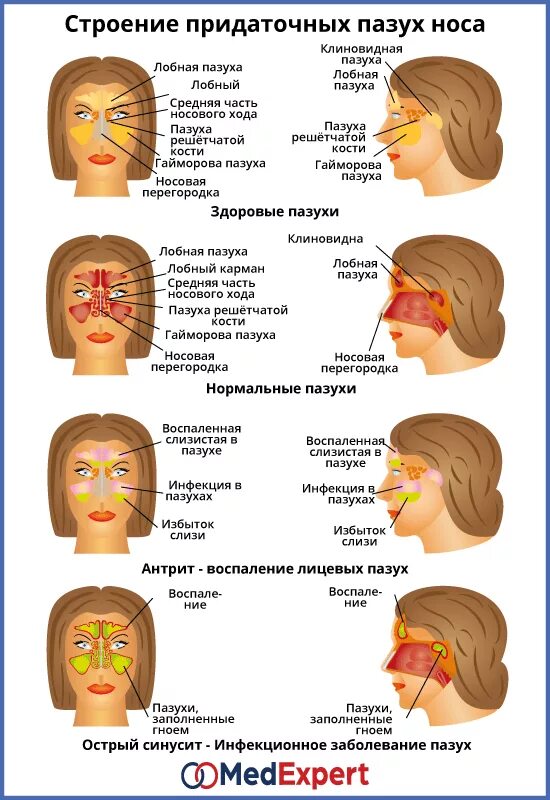 Болит нос при простуде. Синусит придаточных пазух. Воспаление придаточных пазух носа.