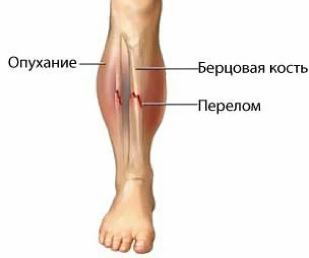 Почему болит кость после перелома. Большеберцовая кость голени. Малоберцовая кость голени. Перелом малой берцовой кости. Перелом голени берцовая кость.