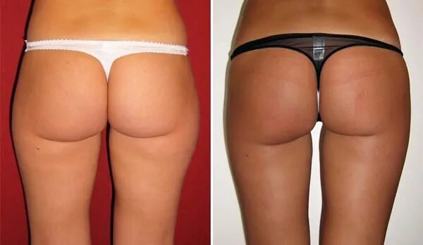 проблемная зона бедра. фигура с галифе на бедрах. галифе у женщин. галифе у женщин. галифе у женщин.