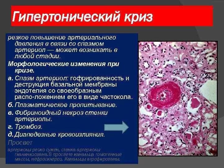 Морфологические изменения болезни. Характерные изменения артериол при гипертонической болезни:. Гиалиноз миокарда гистология. Морфологические изменения при гипертоническом кризе. Гипертонический криз патанатомия.