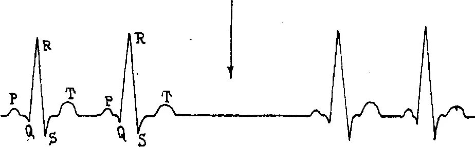 Синоаурикулярная блокада. Синоаурикулярная блокада на ЭКГ. Внутрипредсердная блокада на ЭКГ. Арборизационная блокада на ЭКГ. ЭКГ-критерии синоаурикулярной блокады рисунки.