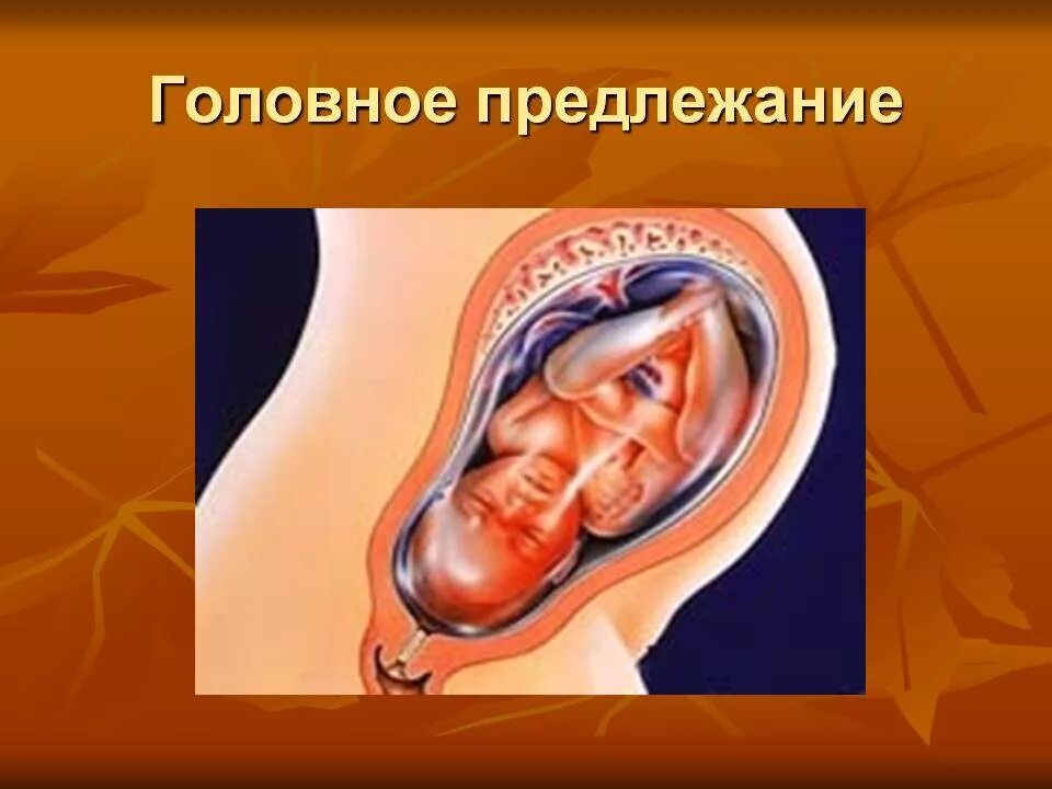 Продольное расположение плода при беременности 32 недели. Головное продольное предлежание плода при беременности. Головное предлежание фото. Головное продольное предлежание плода фото. Продольное расположение плода при беременности 32 недели.