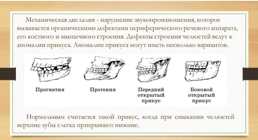 Аномалии органов артикуляции. Механическая дислалия анатомические дефекты органов артикуляции. нарушения прикуса в логопедии. прогнатия прикус в логопедии.