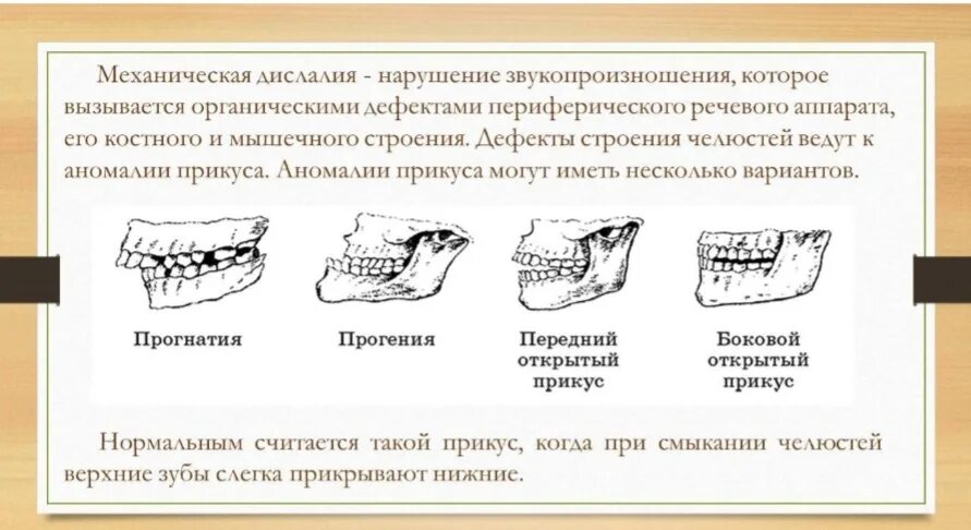 Механическая дислалия. Органическая дислалия. Дефекты механической дислалии. Прогнатия прикус в логопедии. Артикуляторная дислалия