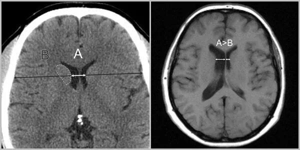 Сосудистое сплетение 4 желудочка. Ассиметрия боковых желудочков кт. Асимметричное расширение боковых желудочков головного мозга. Асимметрия боковых желудочков мрт. Асимметрия боковых желудочков мрт.