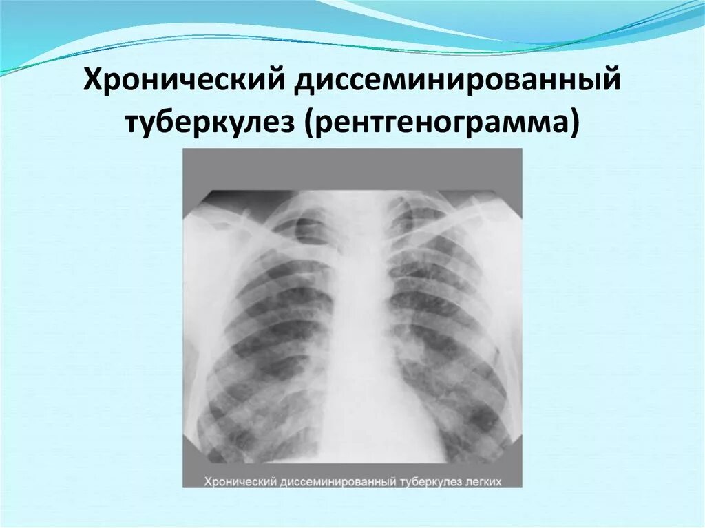 Туберкулез легкого рентгенограмма. Хронический диссеминированный туберкулез. Лимфогенный диссеминированный туберкулез. Диссеминированный туберкулез на рентгенограмме.