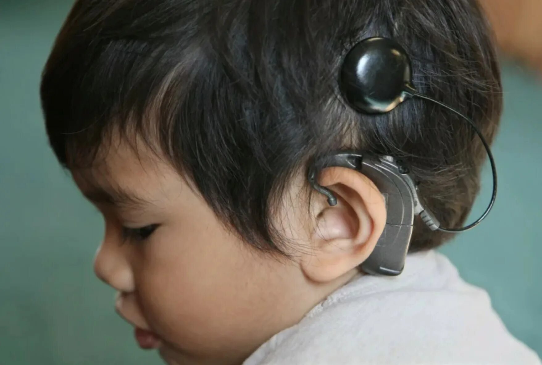 Глухота аномалия. Кохлеарная имплантация Cochlear. Аппарат для глухих кохлеарная имплантация. Кохлеарный имплант Кохлер. Дети с нарушением слуха..
