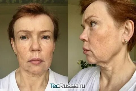 Смас после биоревитализации