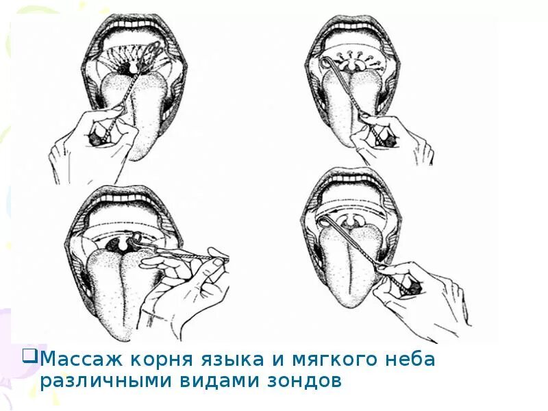 Поднятие мягкого неба. Зондовый логопедический массаж при дизартрии. Массаж при тонусе корня языка. Массаж мягкого неба при дизартрии. Зондовый массаж языка при дизартрии.