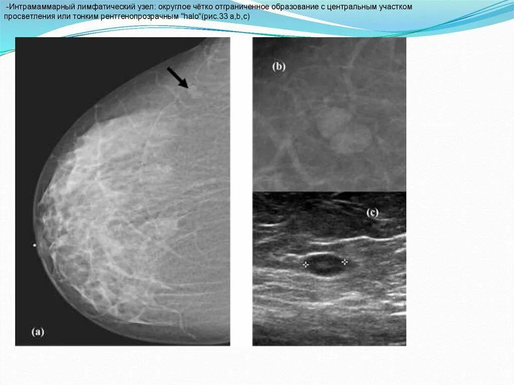 Лимфоузлы молочной железы маммография. Интрамаммарный лимфоузел молочной железы на УЗИ. Интрамаммарный лимфоузел на маммографии. Лимфоузлы молочной железы на УЗИ. Лимфоузлы при рмж