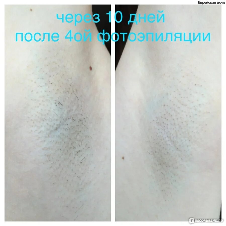 Фотоэпилятор Philips Lumea IPL SC1995/00 - "После бритья ваши ноги выглядят так,